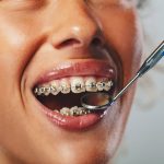 Why Metal Braces Are Still the Most Reliable Orthodontic Option