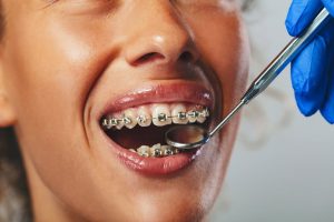 Why Metal Braces Are Still the Most Reliable Orthodontic Option